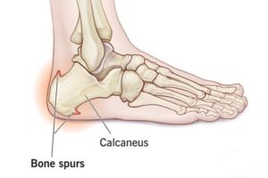 How to Dissolve Bone Spurs Naturally 