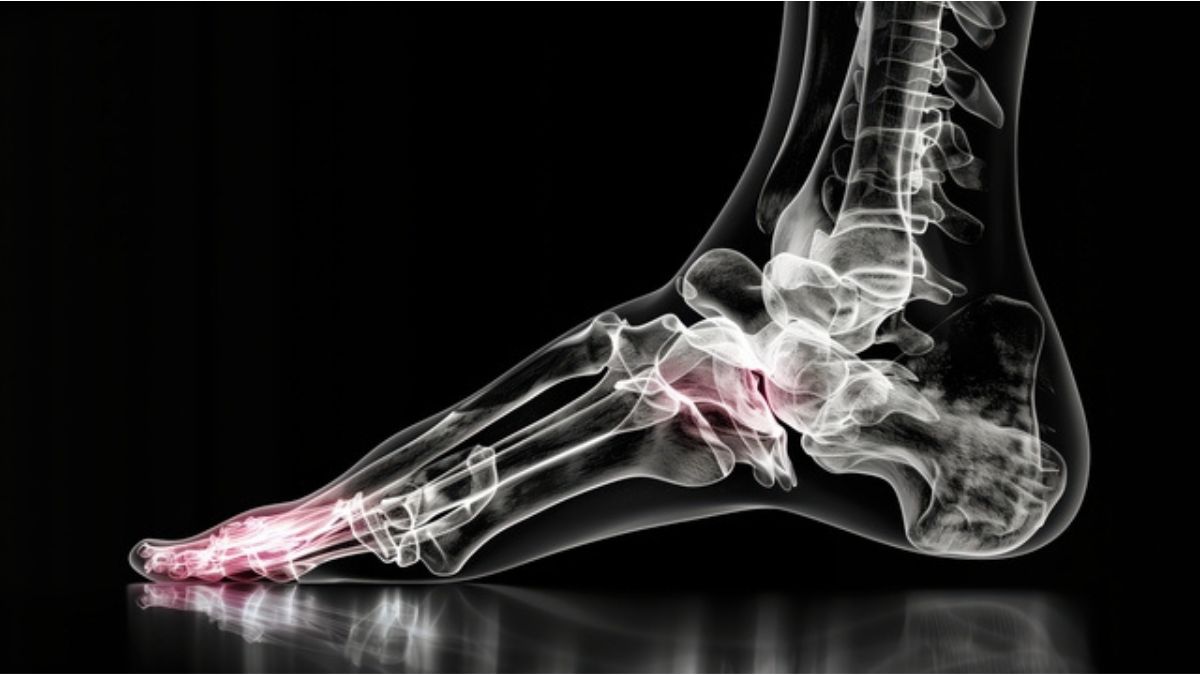 How to Dissolve Bone Spurs Naturally