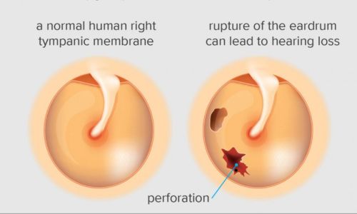 what side should i sleep on with a ruptured eardrum